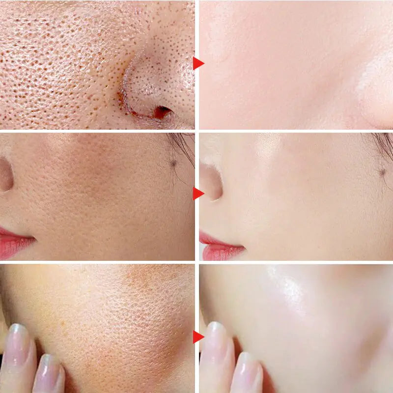 Herbal Acne Removal Face Cream - Afrotix