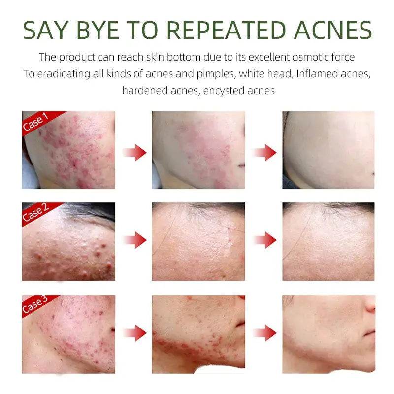 Herbal Acne Removal Face Cream - Afrotix