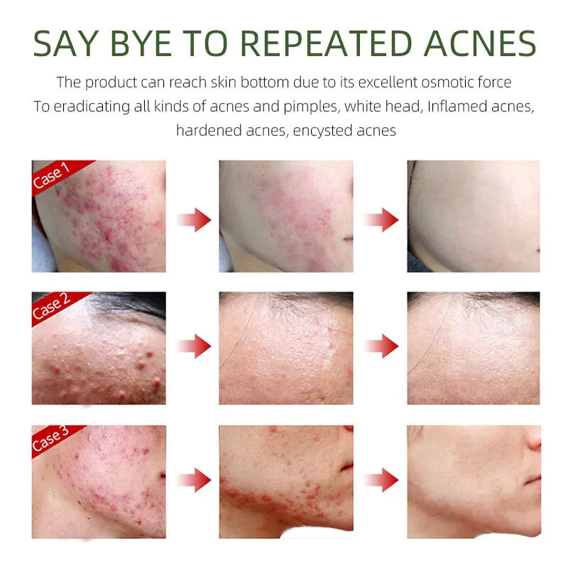 Herbal Acne Removal Face Cream - Afrotix