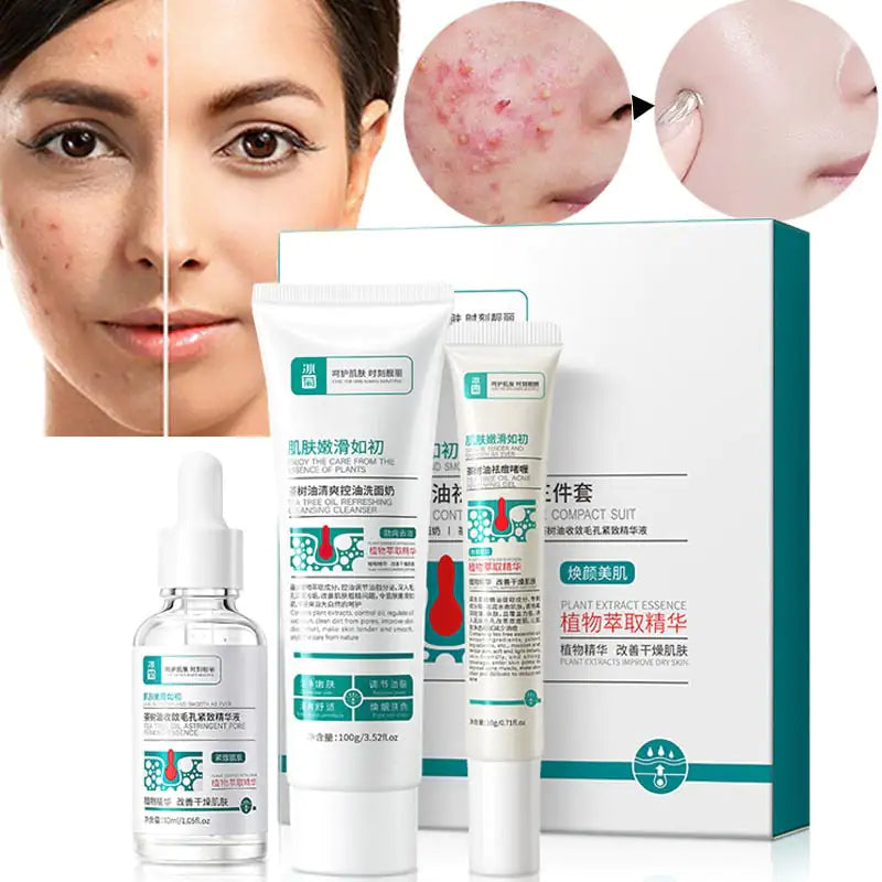 Herbal Acne Removal Face Cream - Afrotix