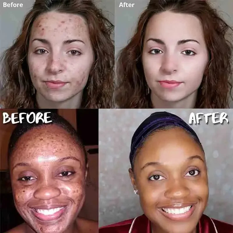 Turmeric Soap Face Cleansing Anti Acne - Afrotix