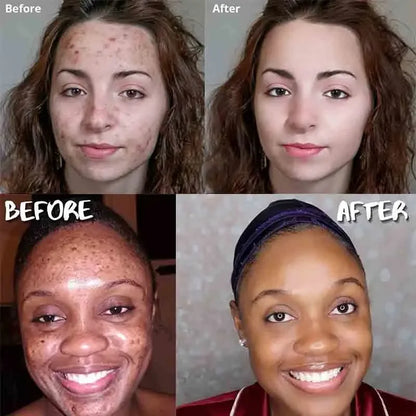 Turmeric Soap Face Cleansing Anti Acne - Afrotix