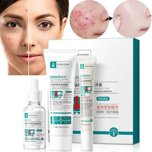 Herbal Acne Removal Face Cream - Afrotix